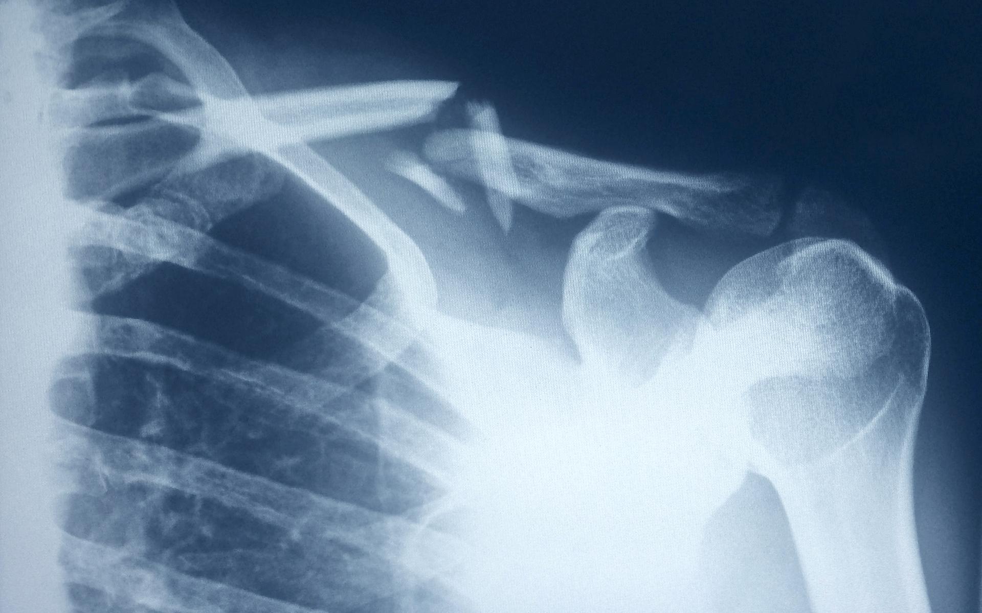 X-Ray of a broken Shoulder