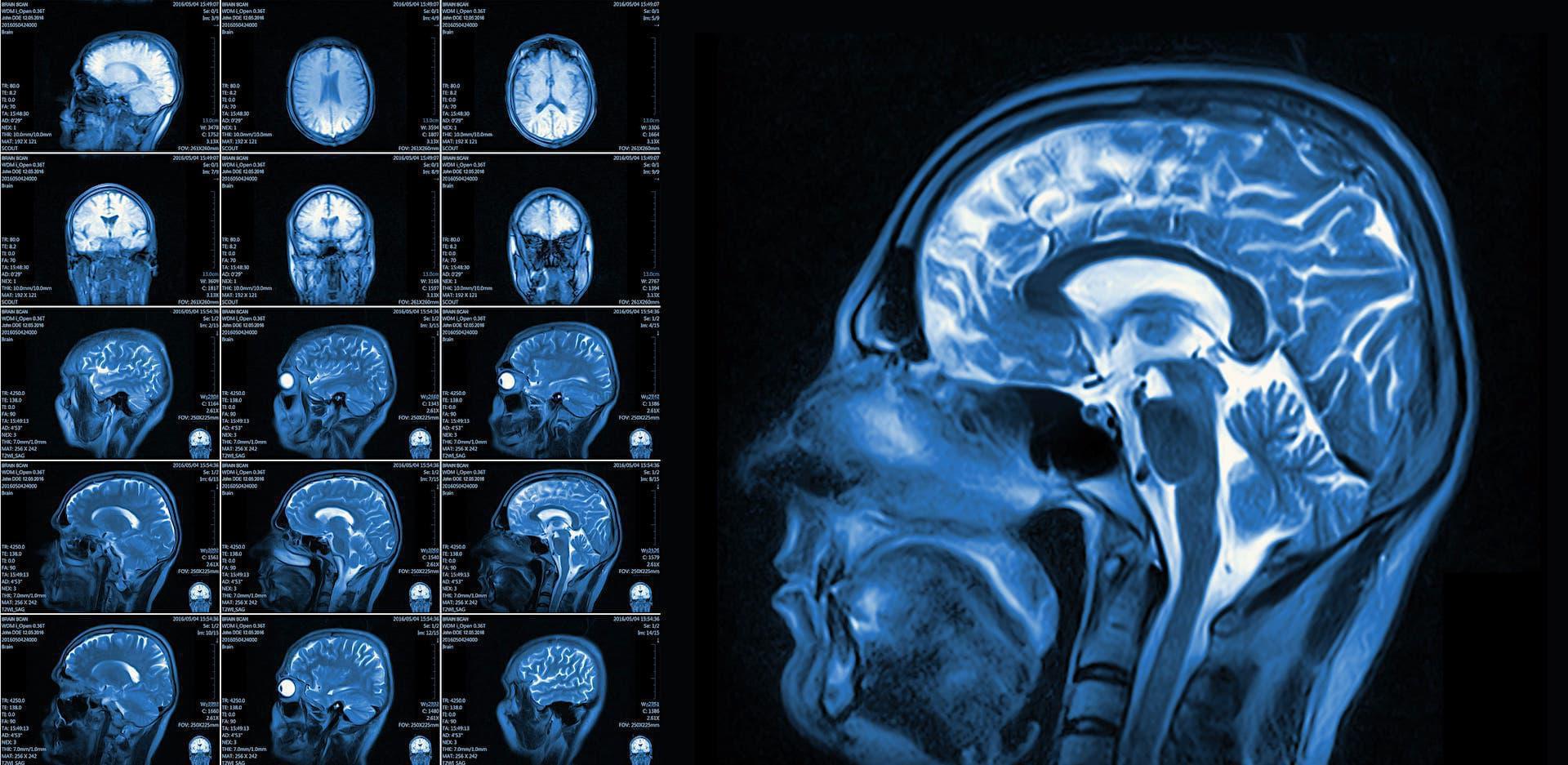 X-Ray of a Head Injury