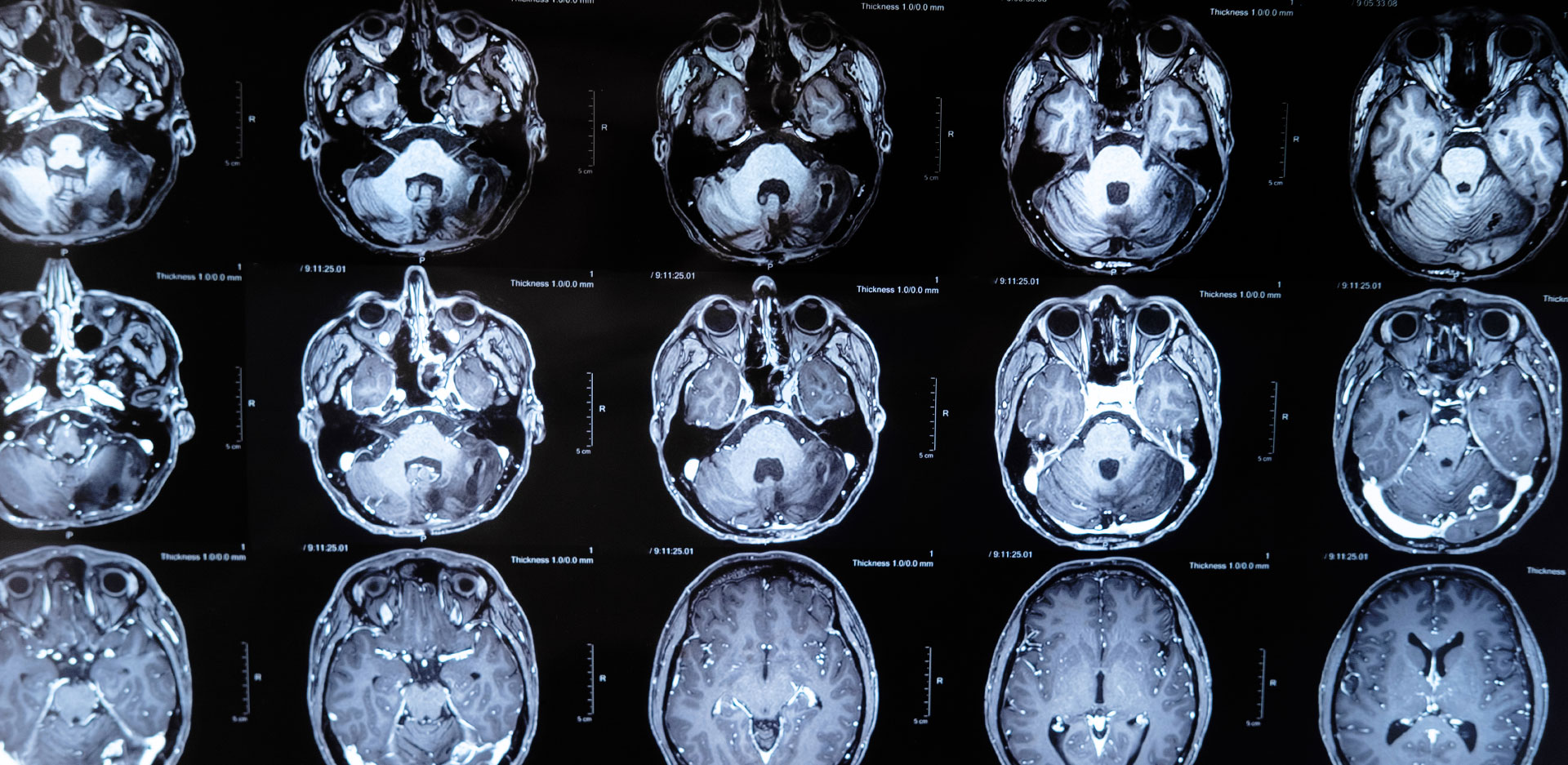 x-ray-head injury